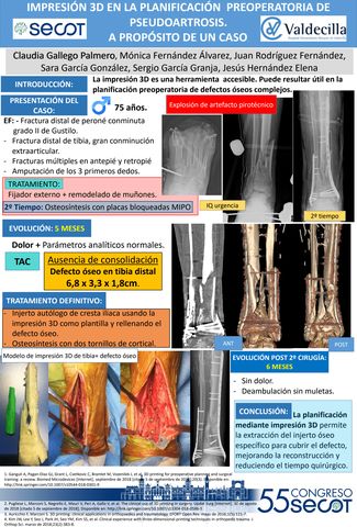 Fascitis Plantar - Doctor Sergio Garcia Granja